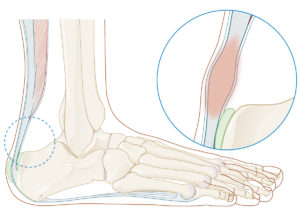 Pijnlijke achillespees