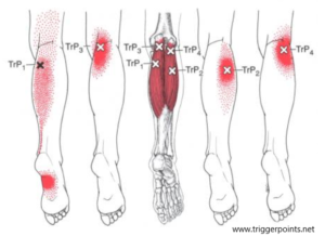 Dry needling