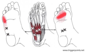 Dry needling